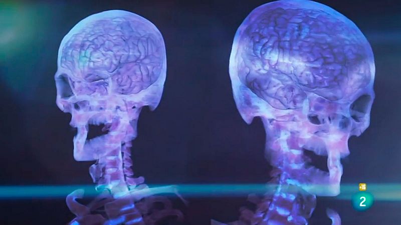 El cerebro de un psicópta tiene unos rasgos diferenciales