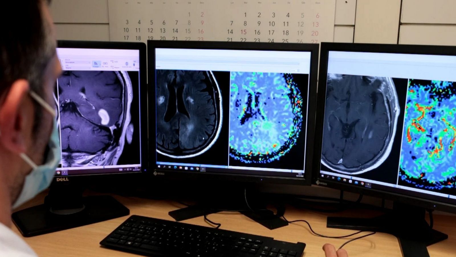 Nueva herramienta de Inteligencia Artificial para el diagnóstico de tumores cerebrales