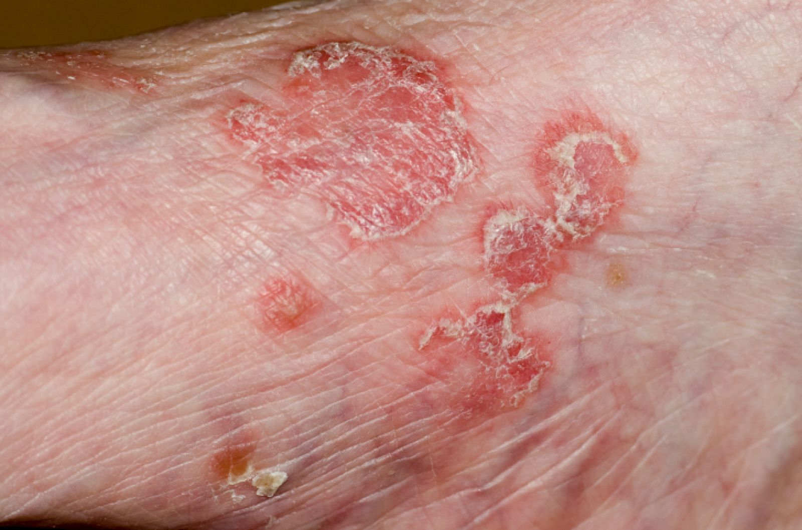 Un brazo con psoriasis