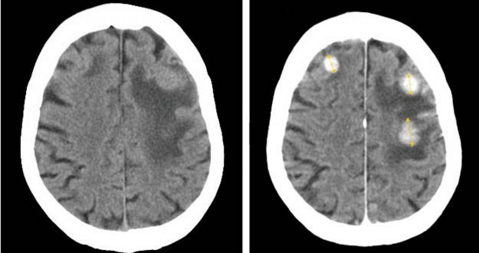 Tomografía computarizada de tres metástasis cerebrales