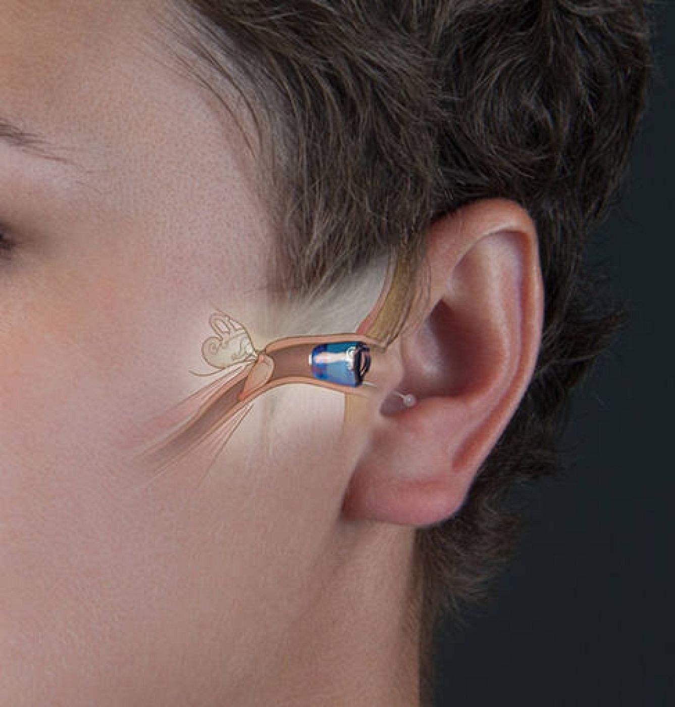  Uno de los minúsculos audífonos presentados.