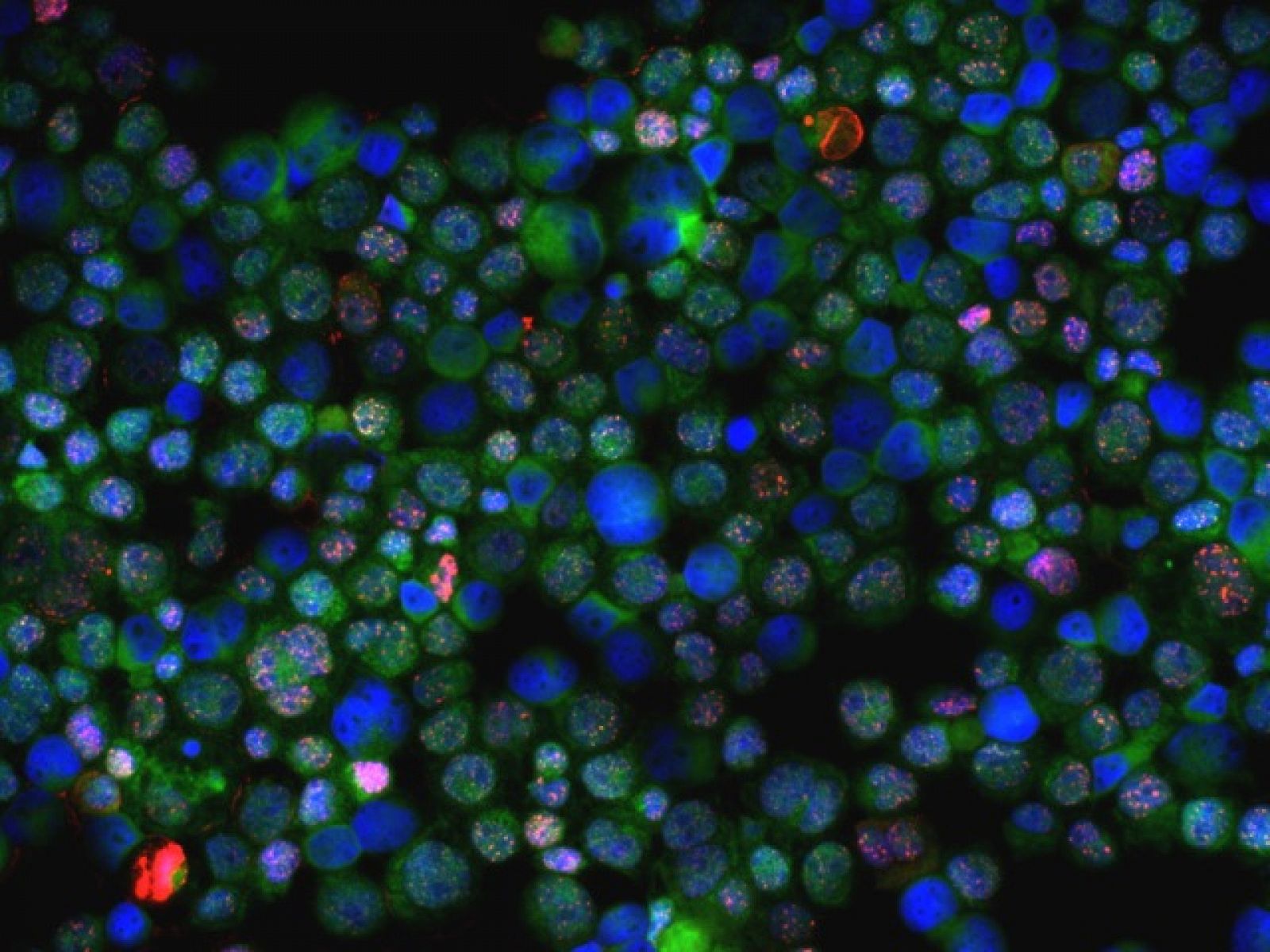 Células con daño en el ADN (rojo) procedentes de una mujer portadora de mutaciones en genes BRCA