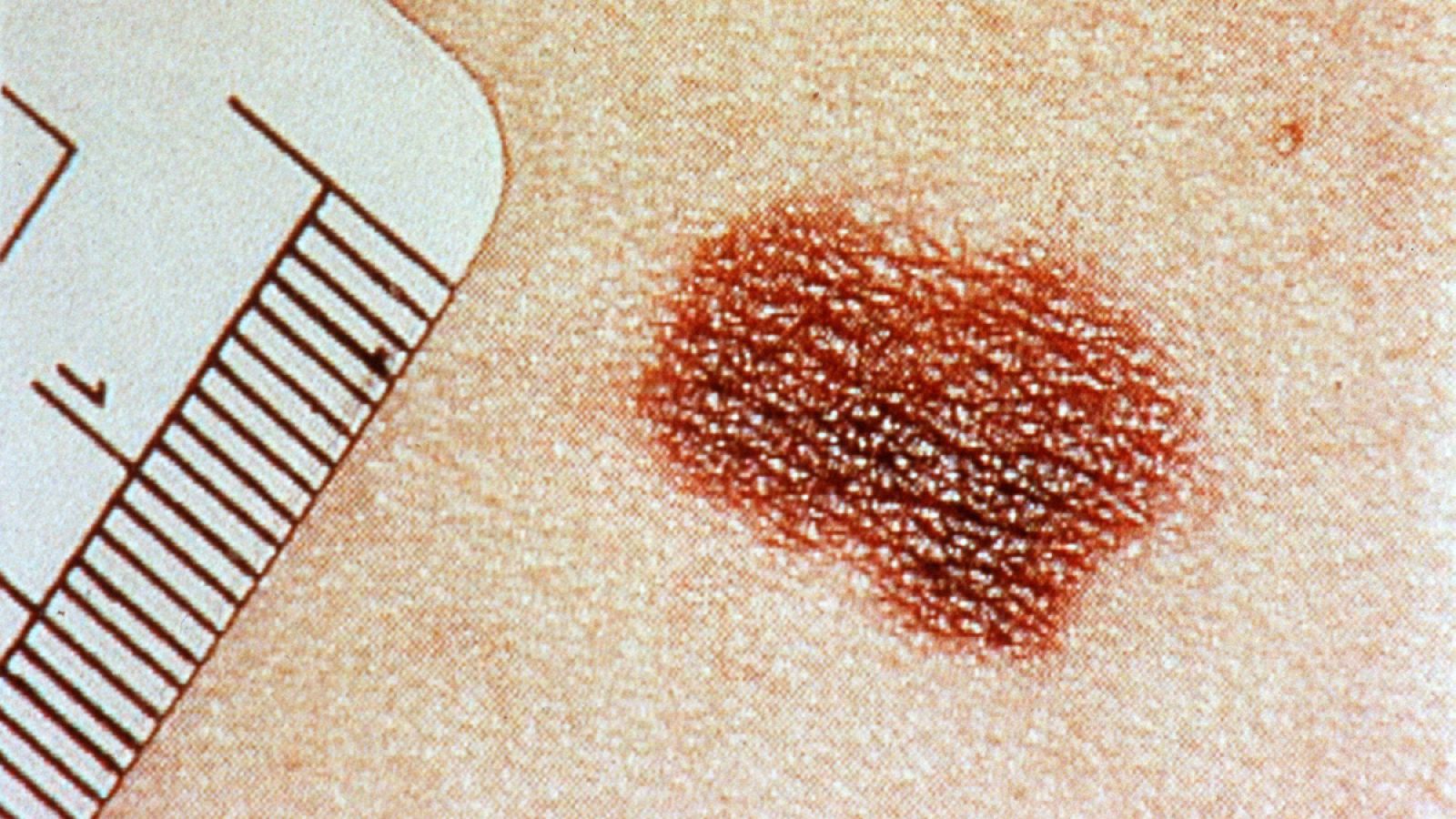 Fotografía de un melanoma en la piel