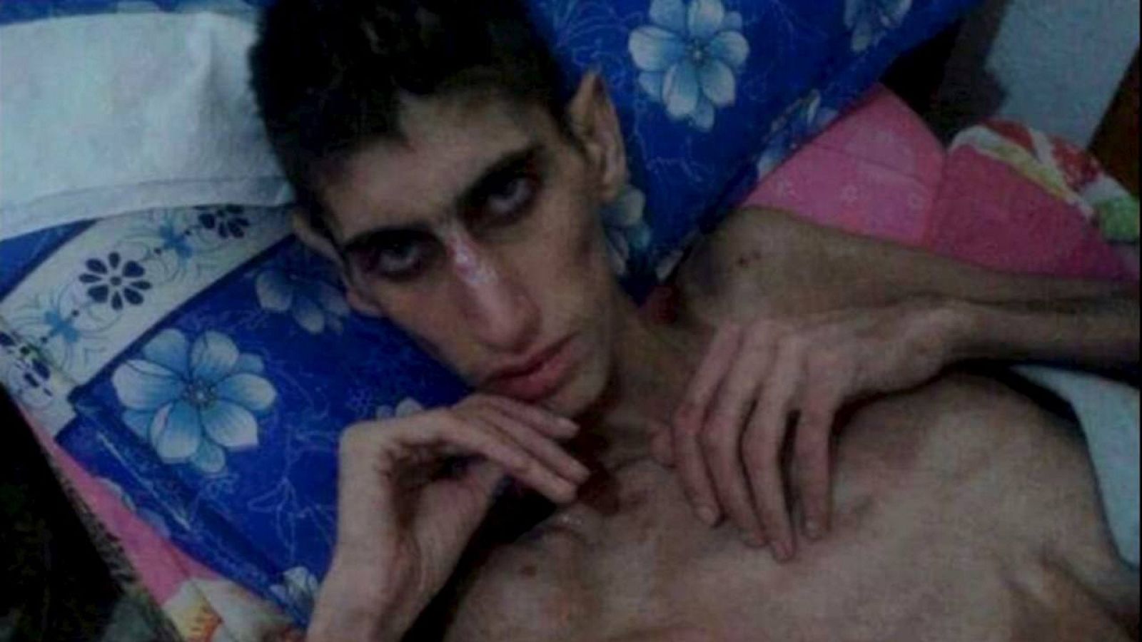 Un vecino de la ciudad sitiada de Madaya, con síntomas agudos de desnutrición, en una imagen de agencia tomada de redes sociales