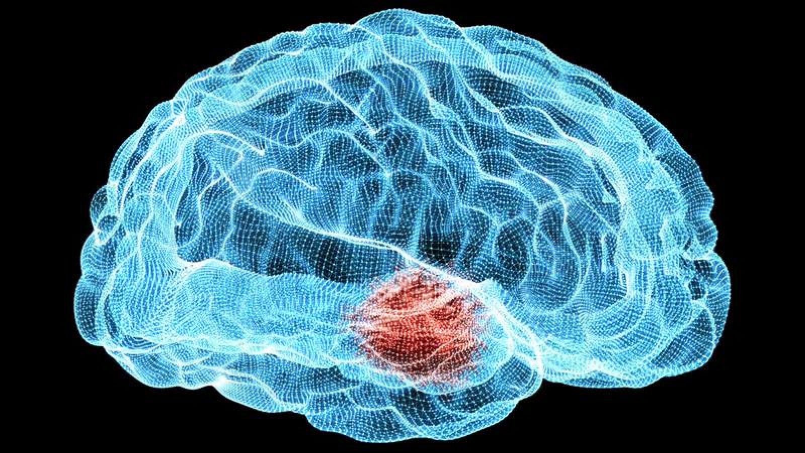 El párkinson es una patología neurodegenerativa irreversible y progresiva.