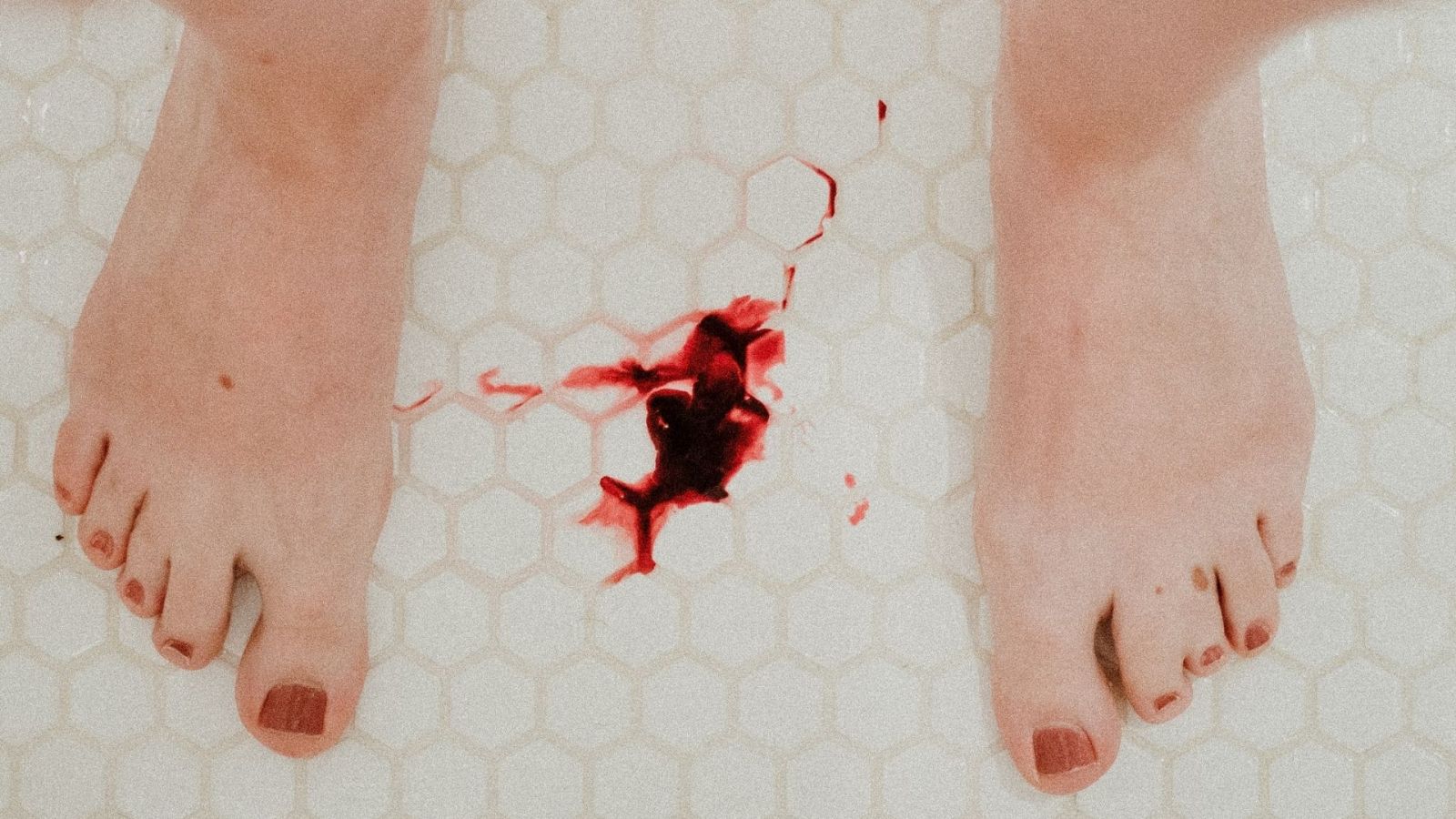 Amenorrea o ausencia de menstruación