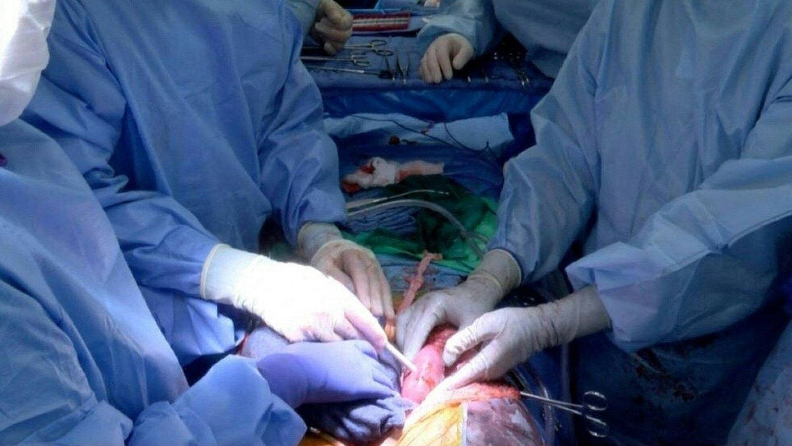 El equipo médico de la Universidad de Alabama, durante la intervención quirúrgica.