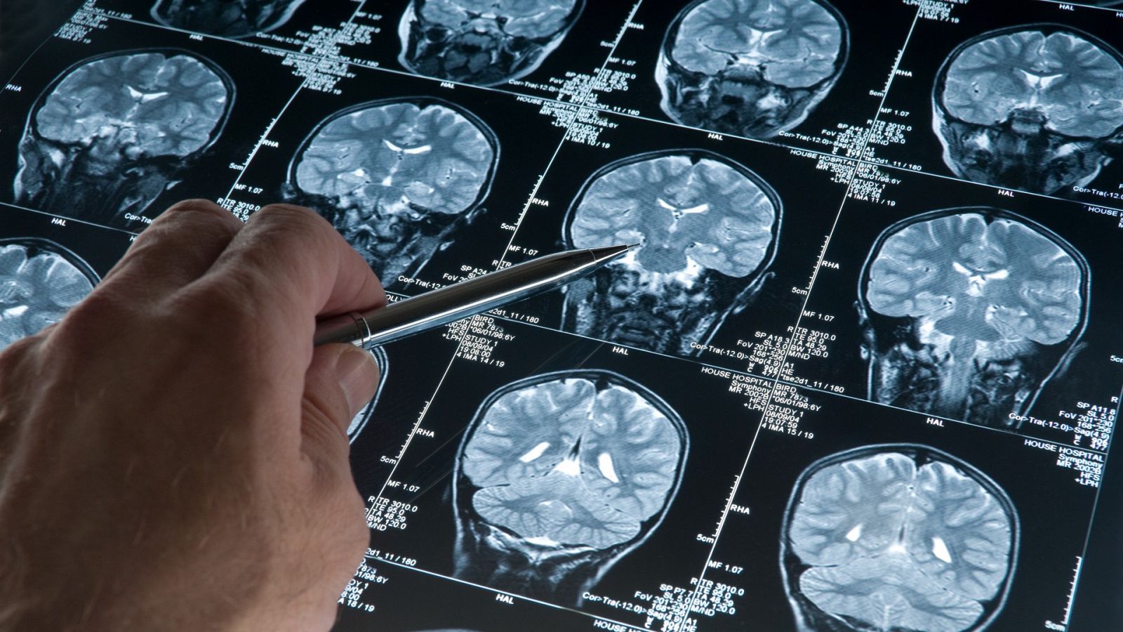Tomografía cerebral en una imagen de archivo