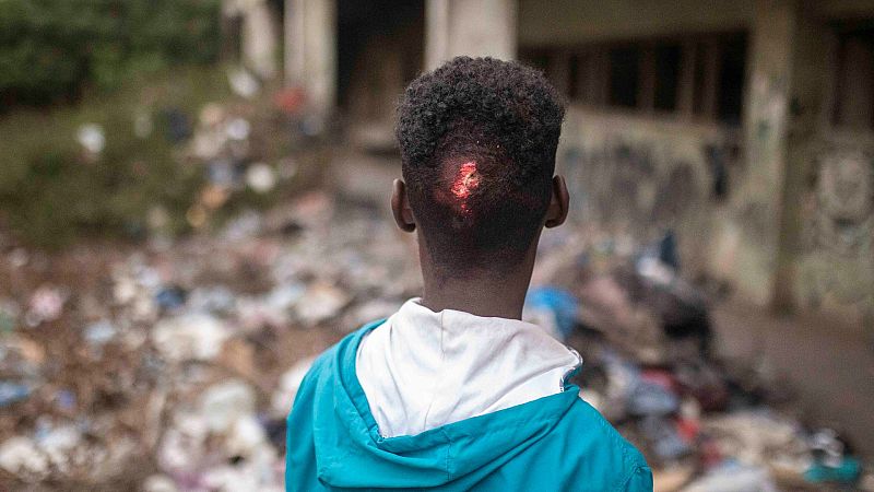 Un joven migrante en un barrio de Casablanca muestra una herida tras intentar saltar la valla de Melilla el pasado 24 de junio