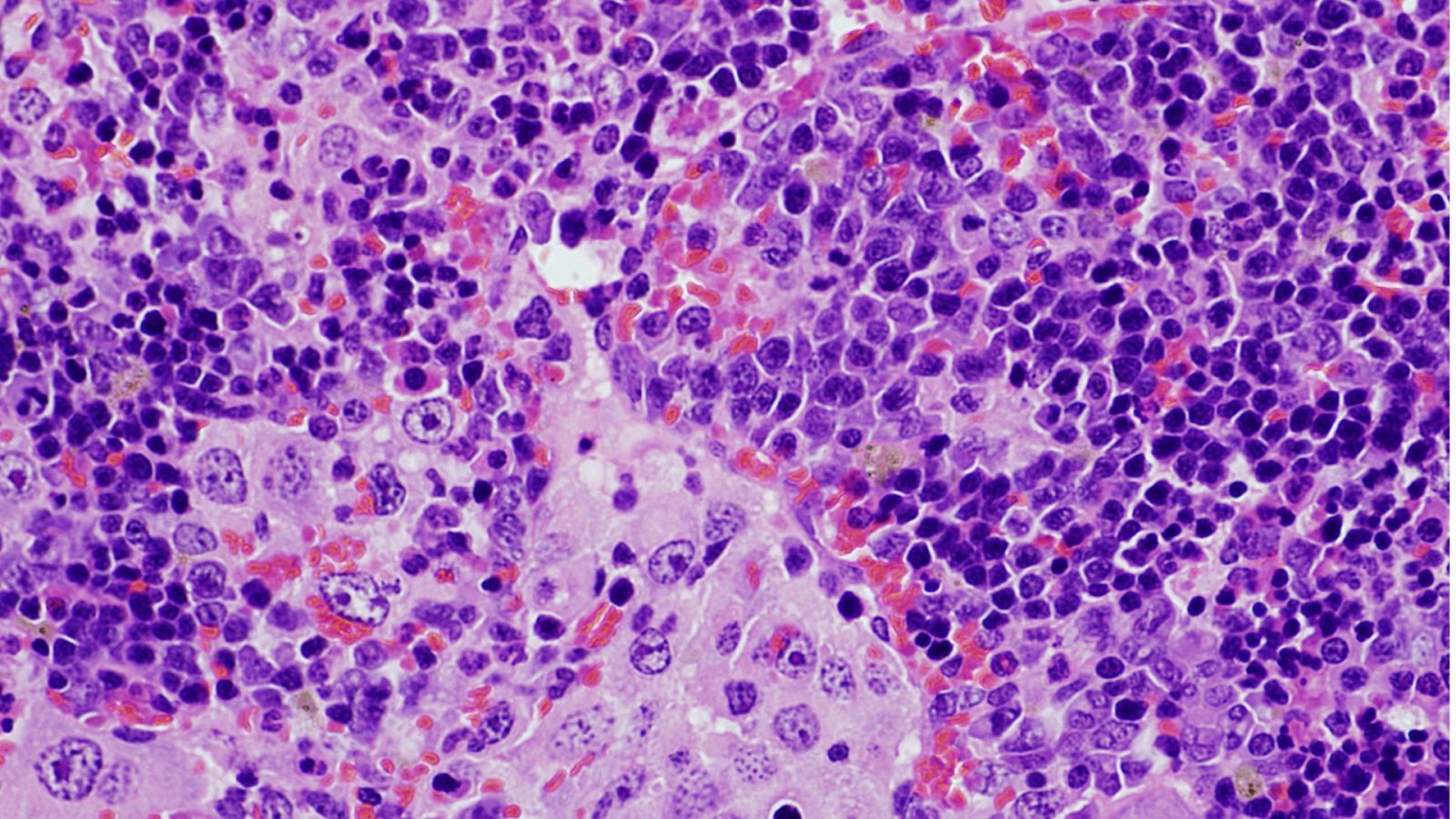 Imagen de microscopía de un bazo que presenta un linfoma