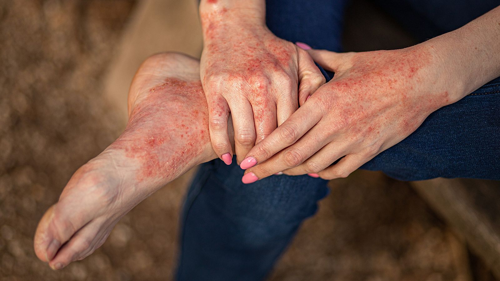 La psoriasis es una enfermedad de la piel que causa un sarpullido con manchas rojas y escamosas.