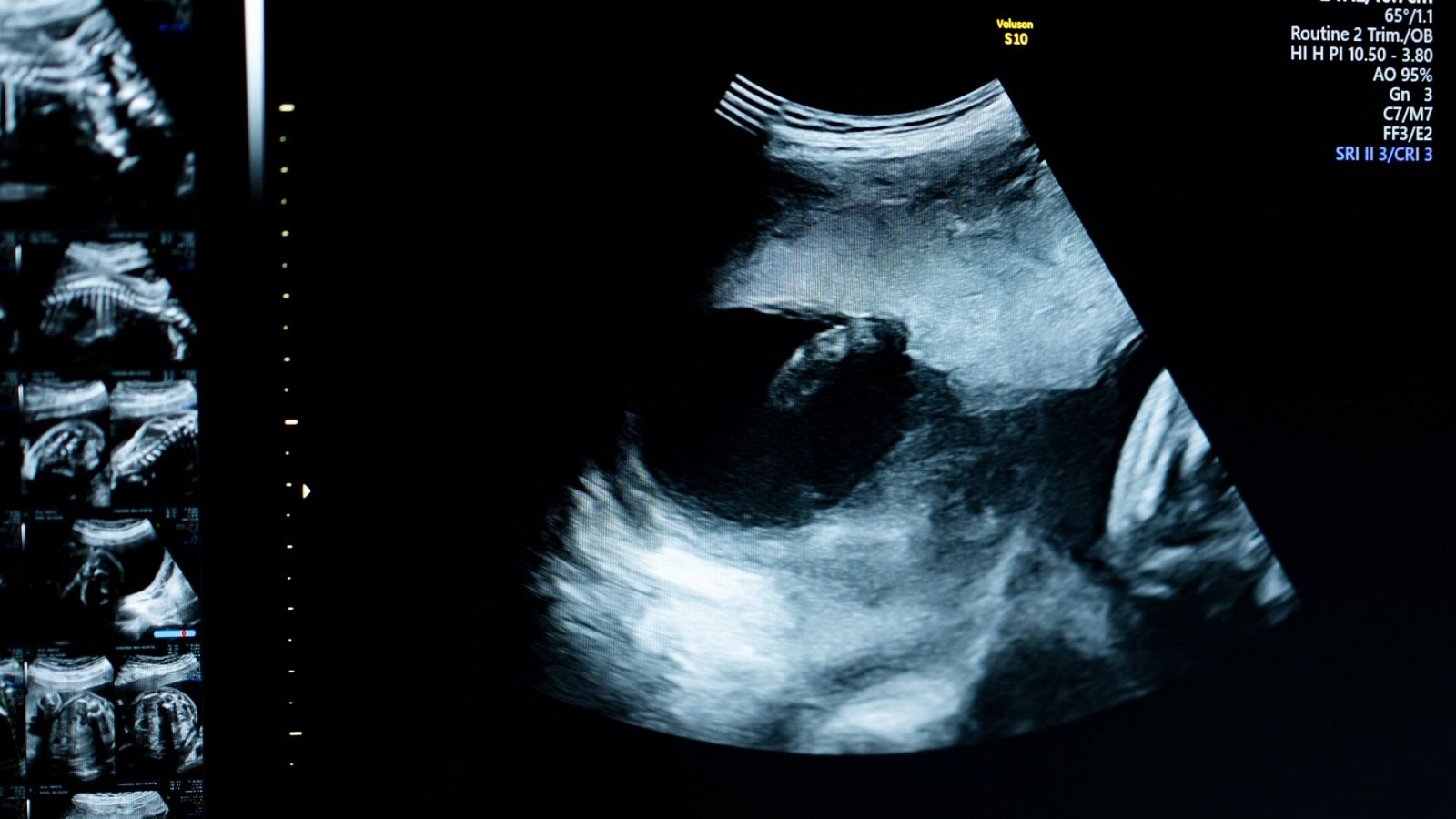 Ecografía de un feto en la semana 22, en una imagen de archivo