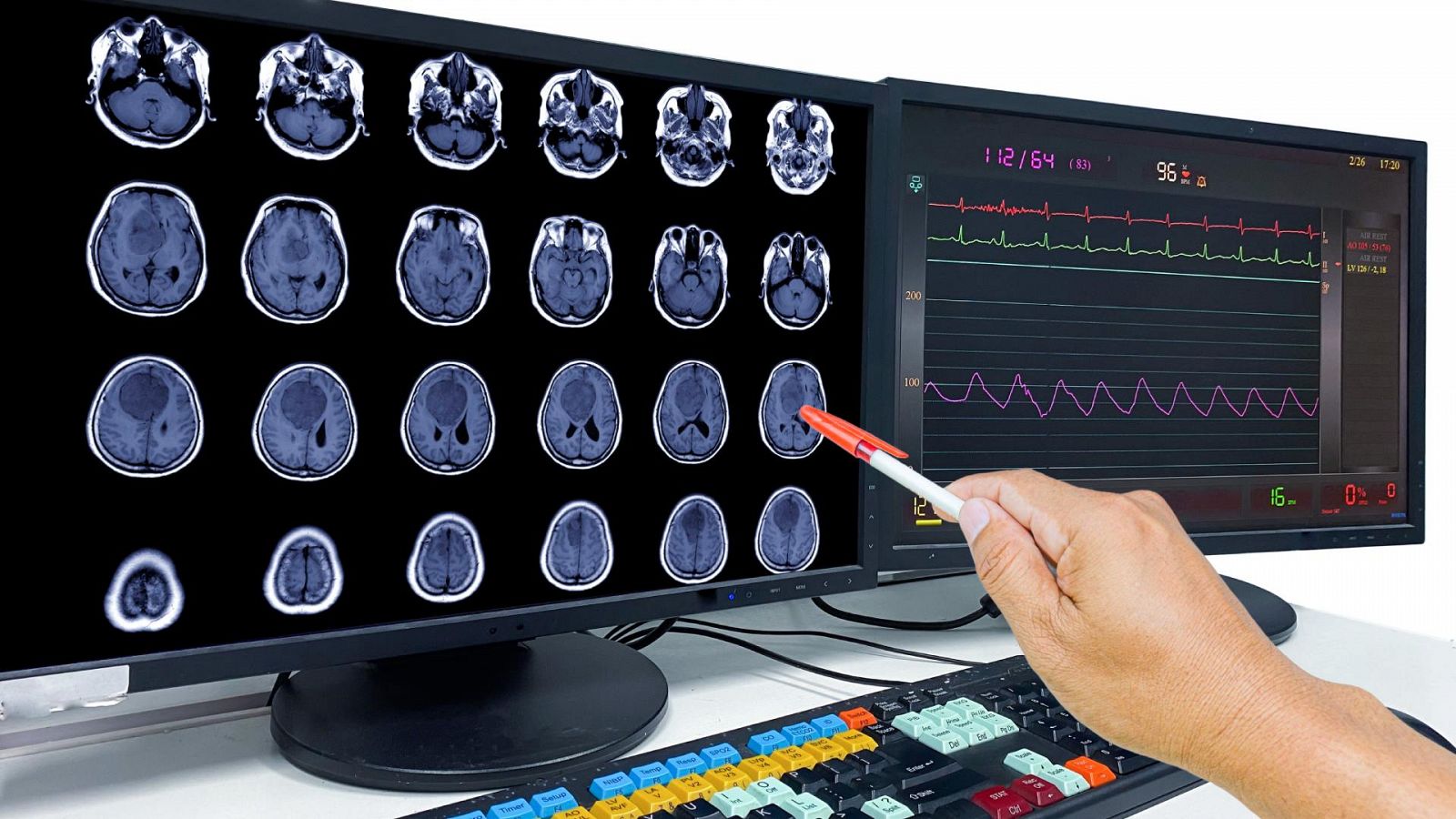 Presencia de un tumor cerebral. en una imagen de archivo