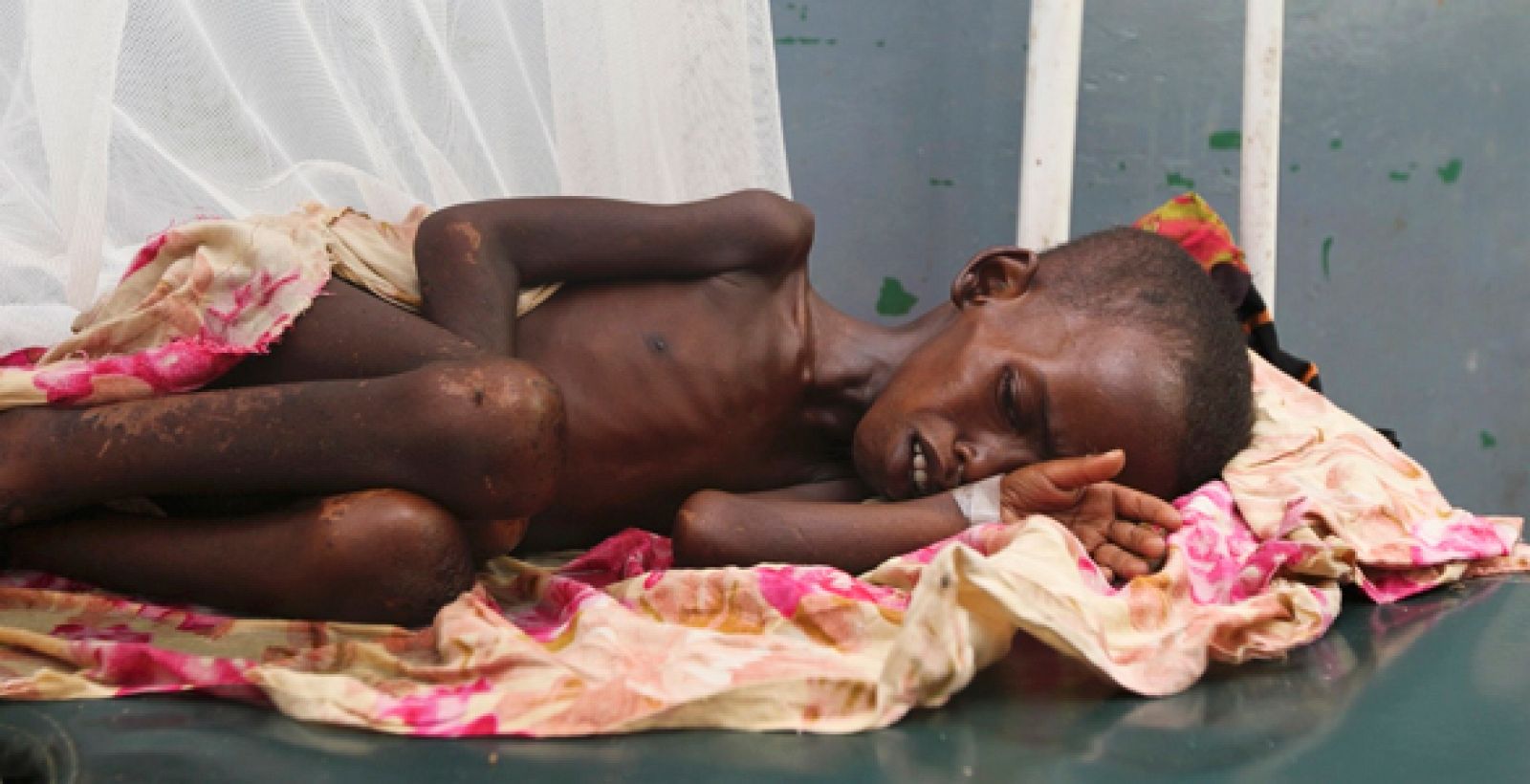 Un niño somalí con malnutrición descansa en el hospital Banadir al sur de Mogadiscio