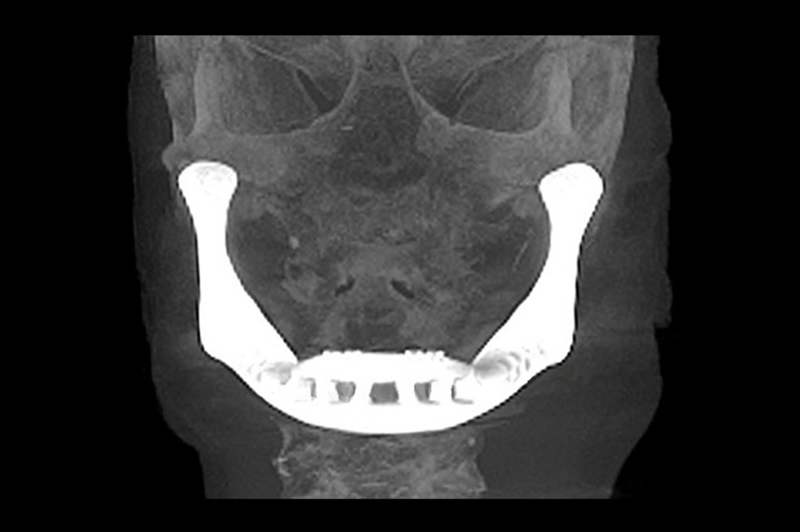 Radiografía de la mandíbula artificial implantada en la paciente