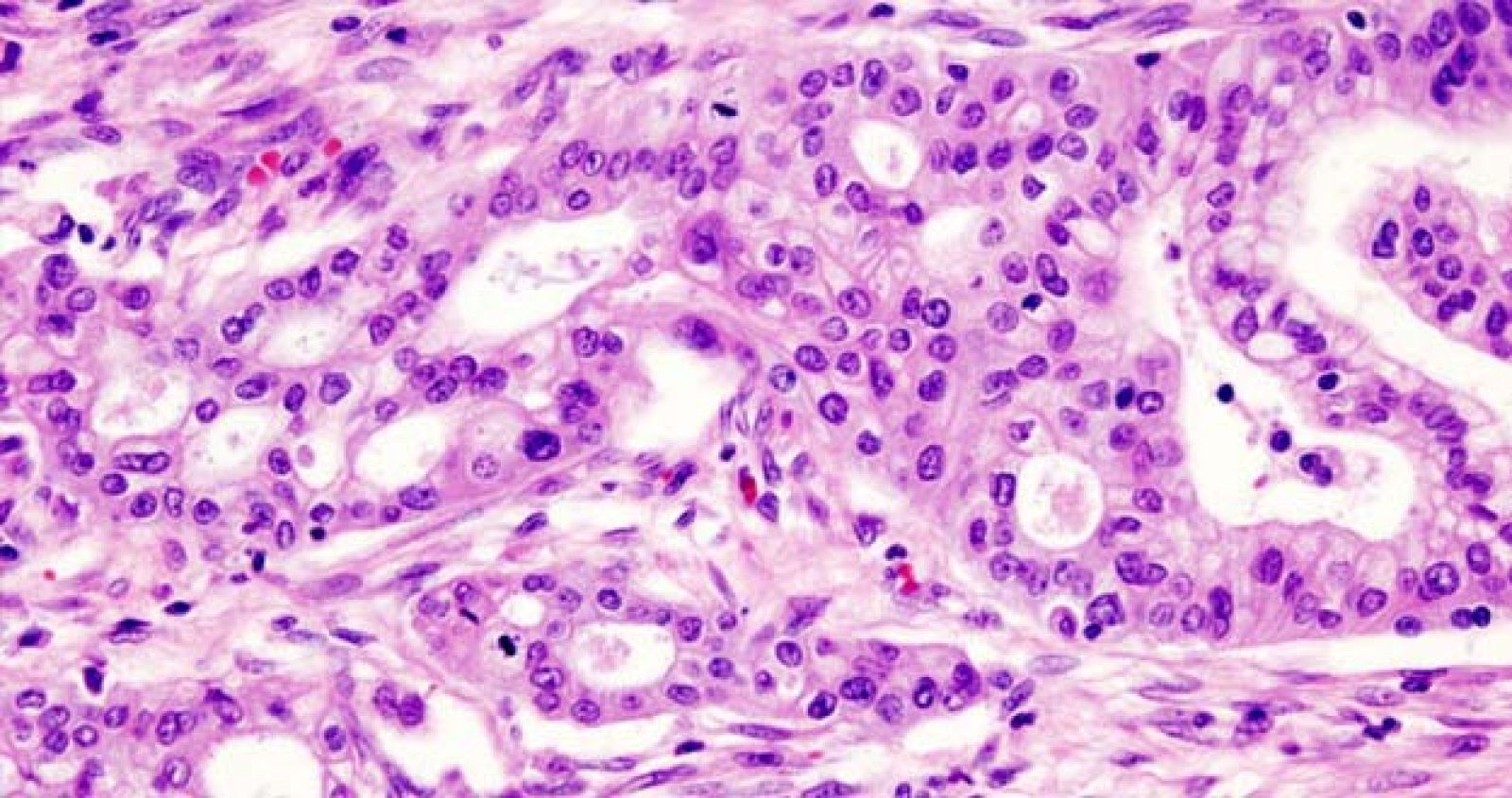 Imagen de un adenocarcinoma de páncreas.