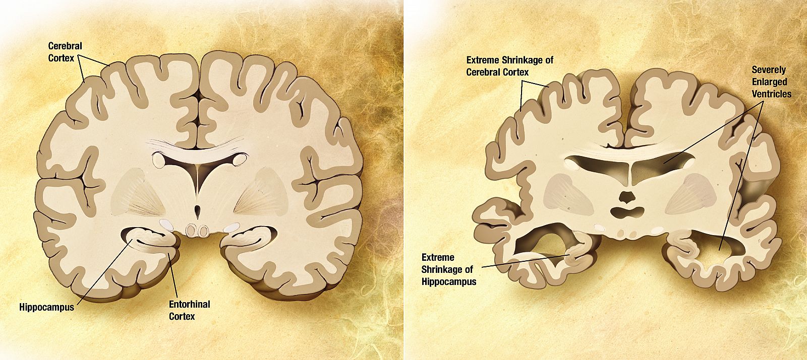 Cerebro sano (izquierda) y cerebro con alzheimer (derecha).