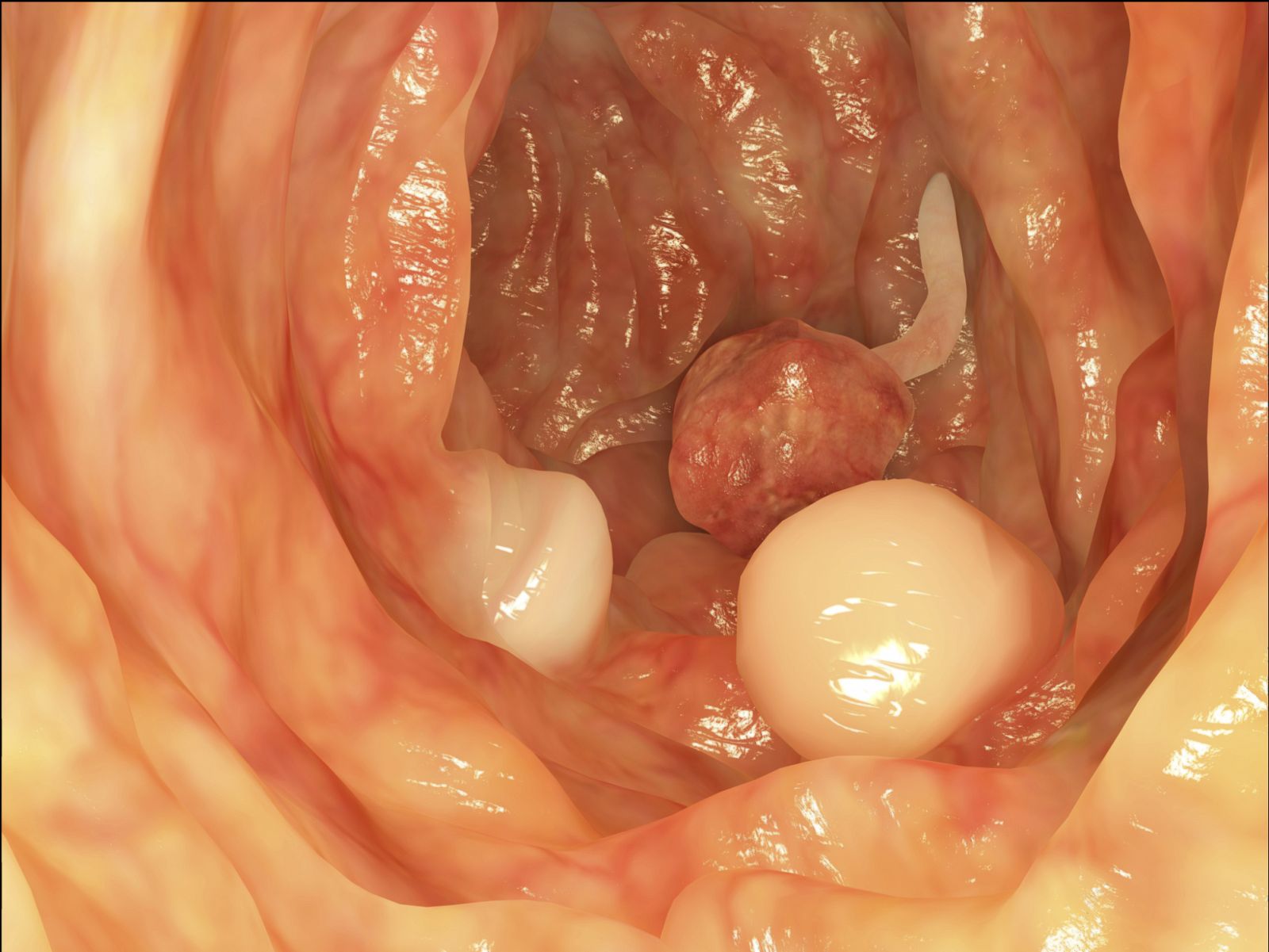 El colon dispone de un mecanismo de seguridad que limita que los pólipos intestinales se conviertan en tumores.