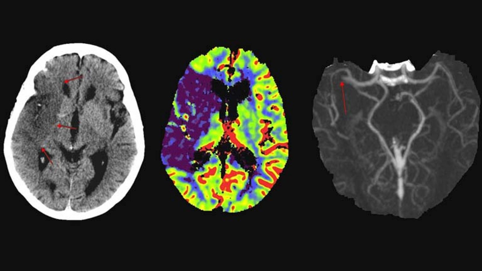 Imágenes de las consecuencias sobre el cerebro de distintos accidentes cerebrovasculares tomadas con Resonancia Magnética.
