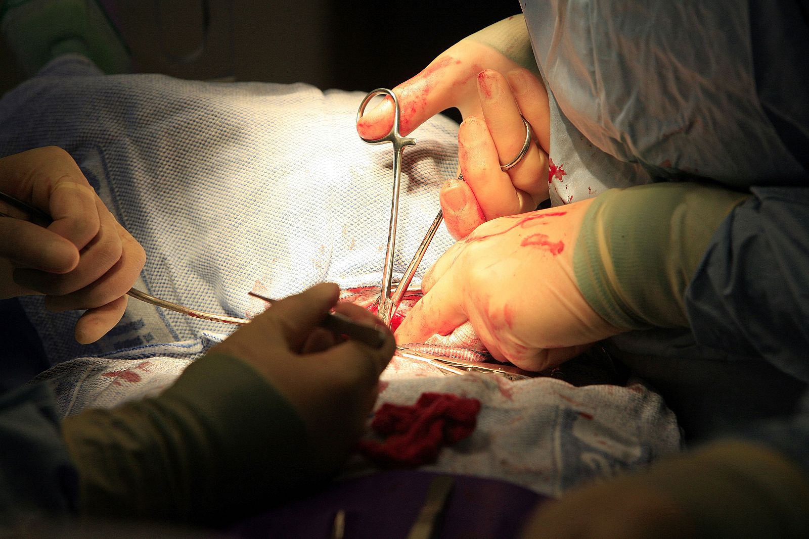 De los 114.690 trasplantes que se realizaron en el mundo en 2013, 77.818 fueron de riñón.