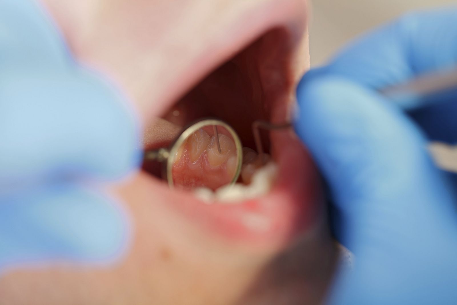 Un dentista examinando una boca.