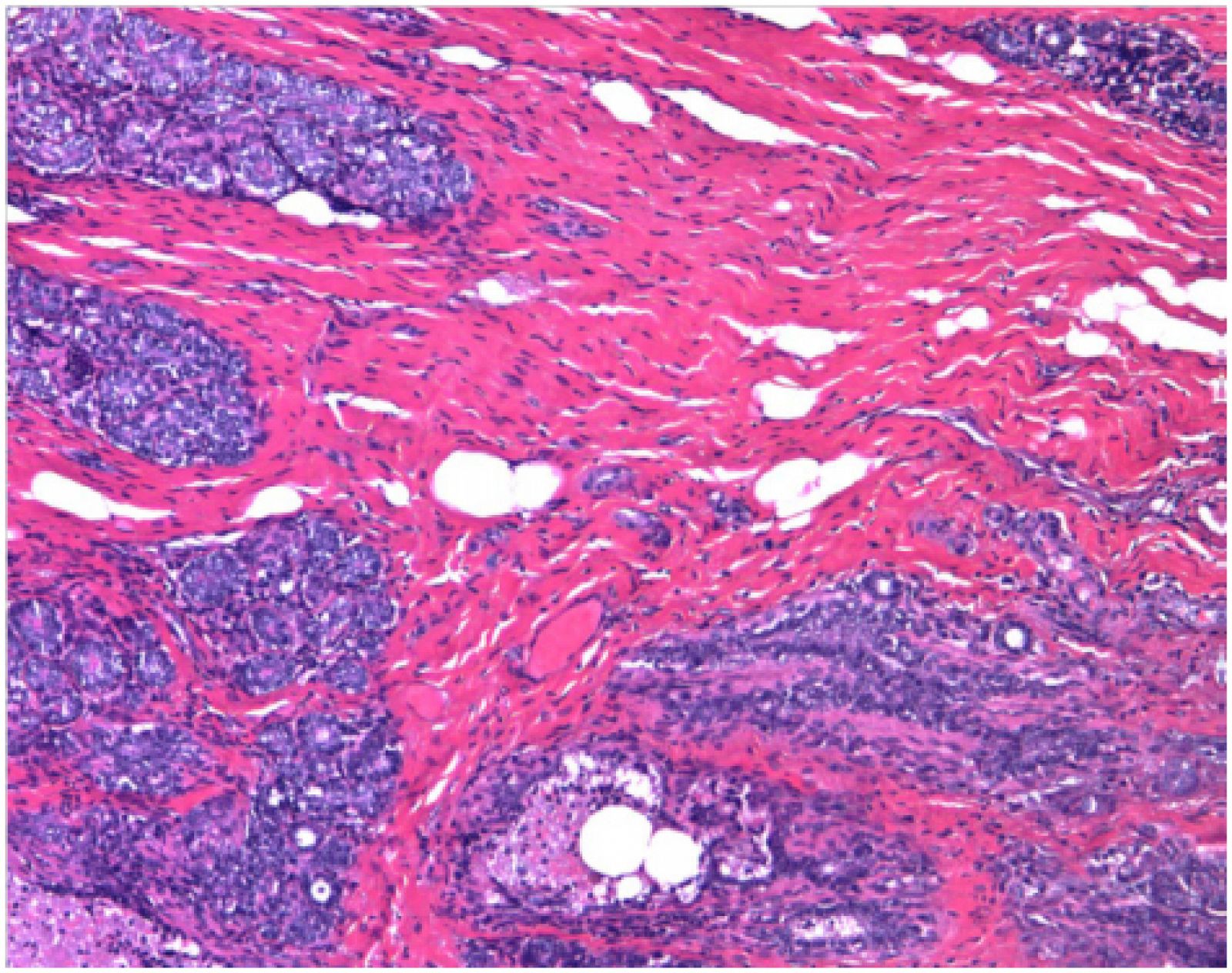Imagen de un tumor de mama identificado como Epi-Luminal B de pronóstico complicado.