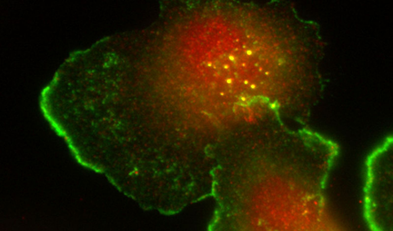 Células tumorales humanas de cáncer de mama teñidas para dos marcadores de invadopodio