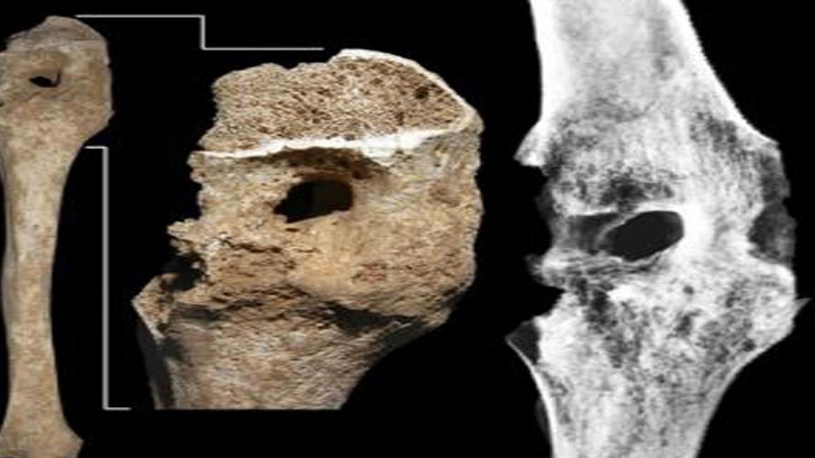 Vista general y detalle de la rodilla herida de los restos de Filipo II y una radiografía de la misma