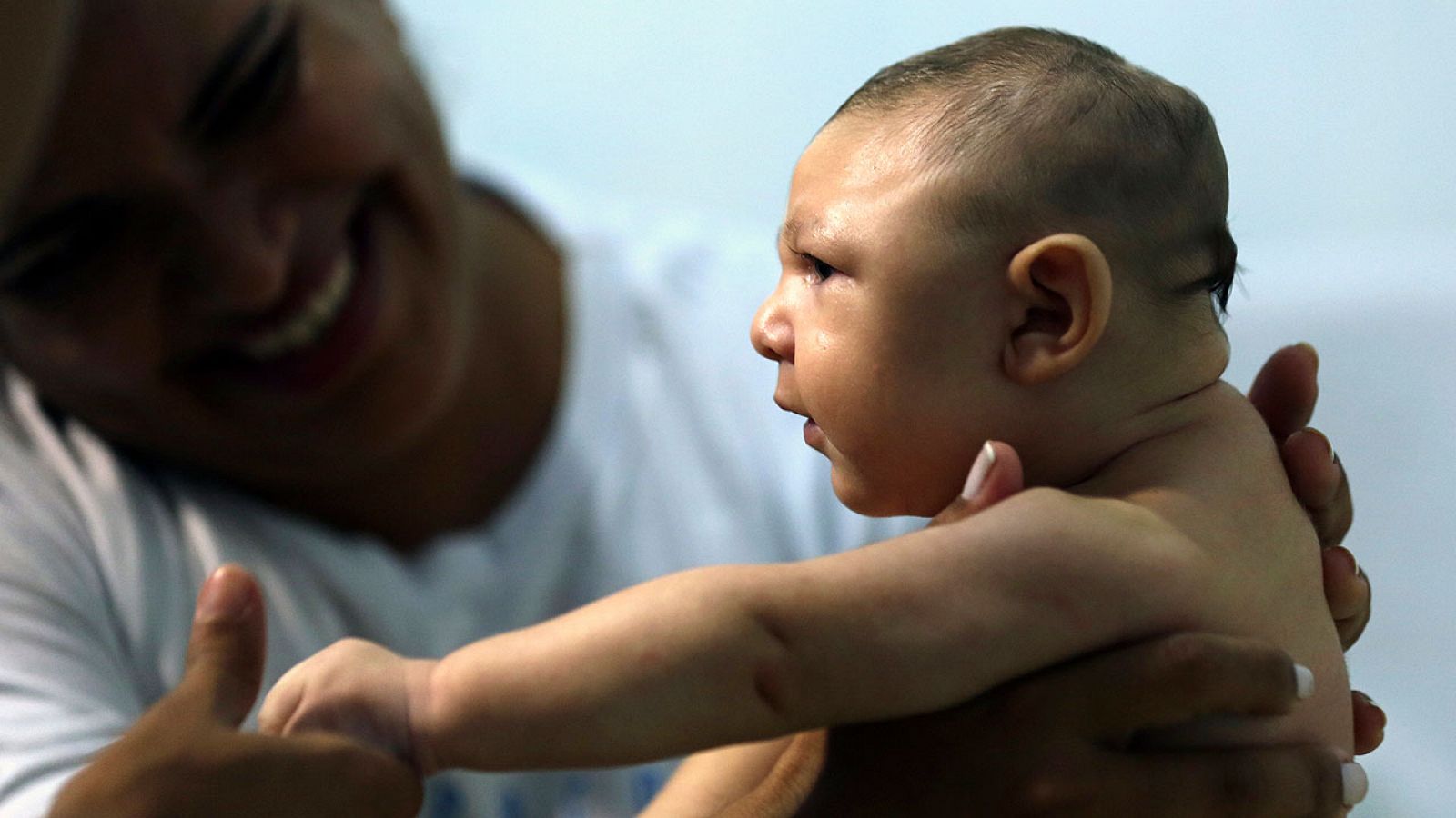 Un bebé afectado de microcefalia en Brasil