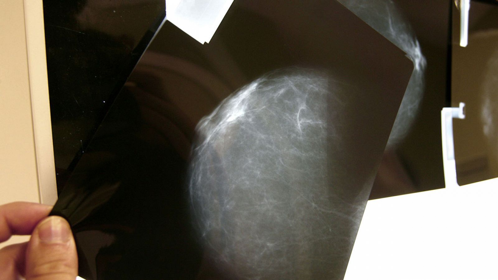 Imagen de archivo de una mamografía