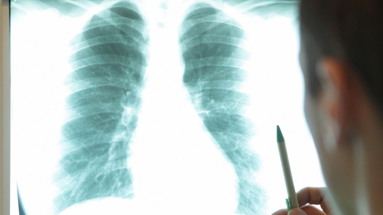 Los expertos esperan dibujar la primera radiografía "real" de la situación de la enfermedad.