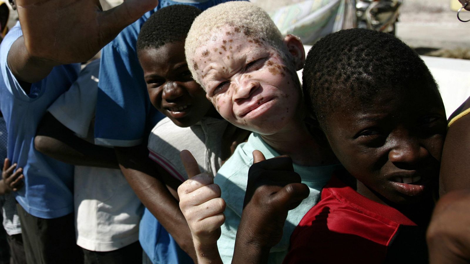 En África, las personas albinas suelen sufrir graves problemas sociales.