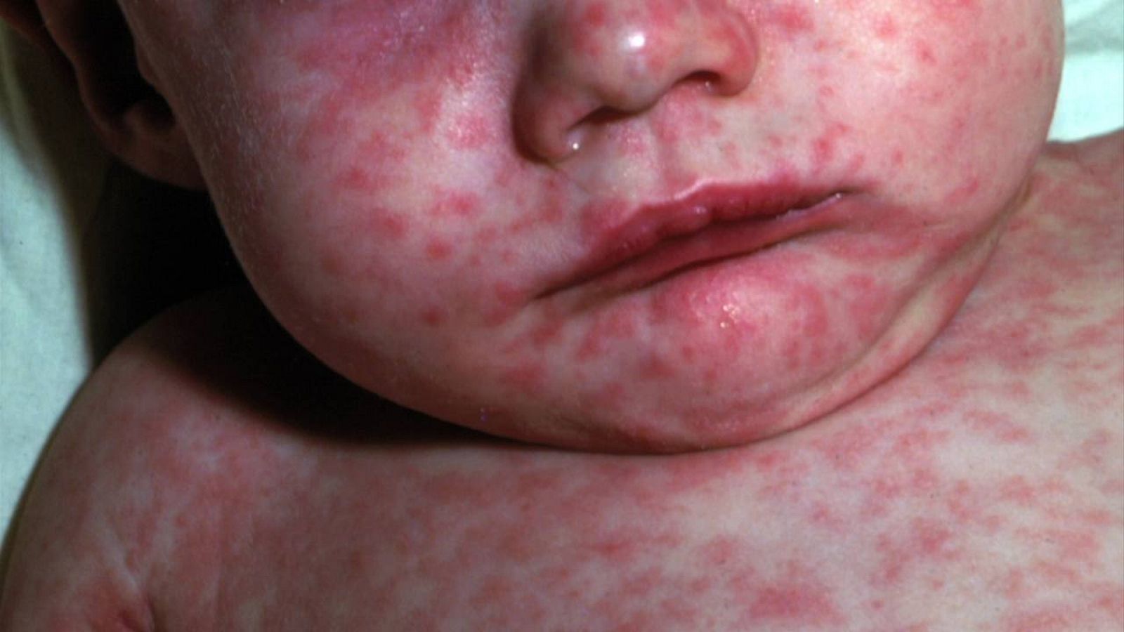 Bebé con enfermedad contagiosa