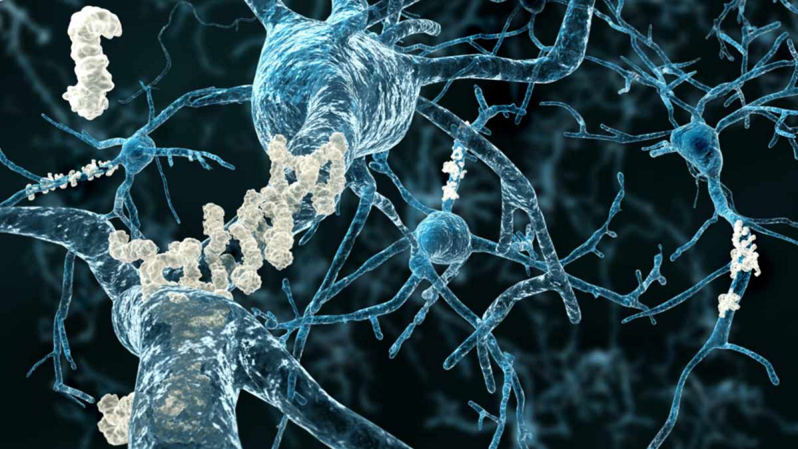 La proteína amiloide se deposita en el cerebro de los enfermos de alzhéimer.