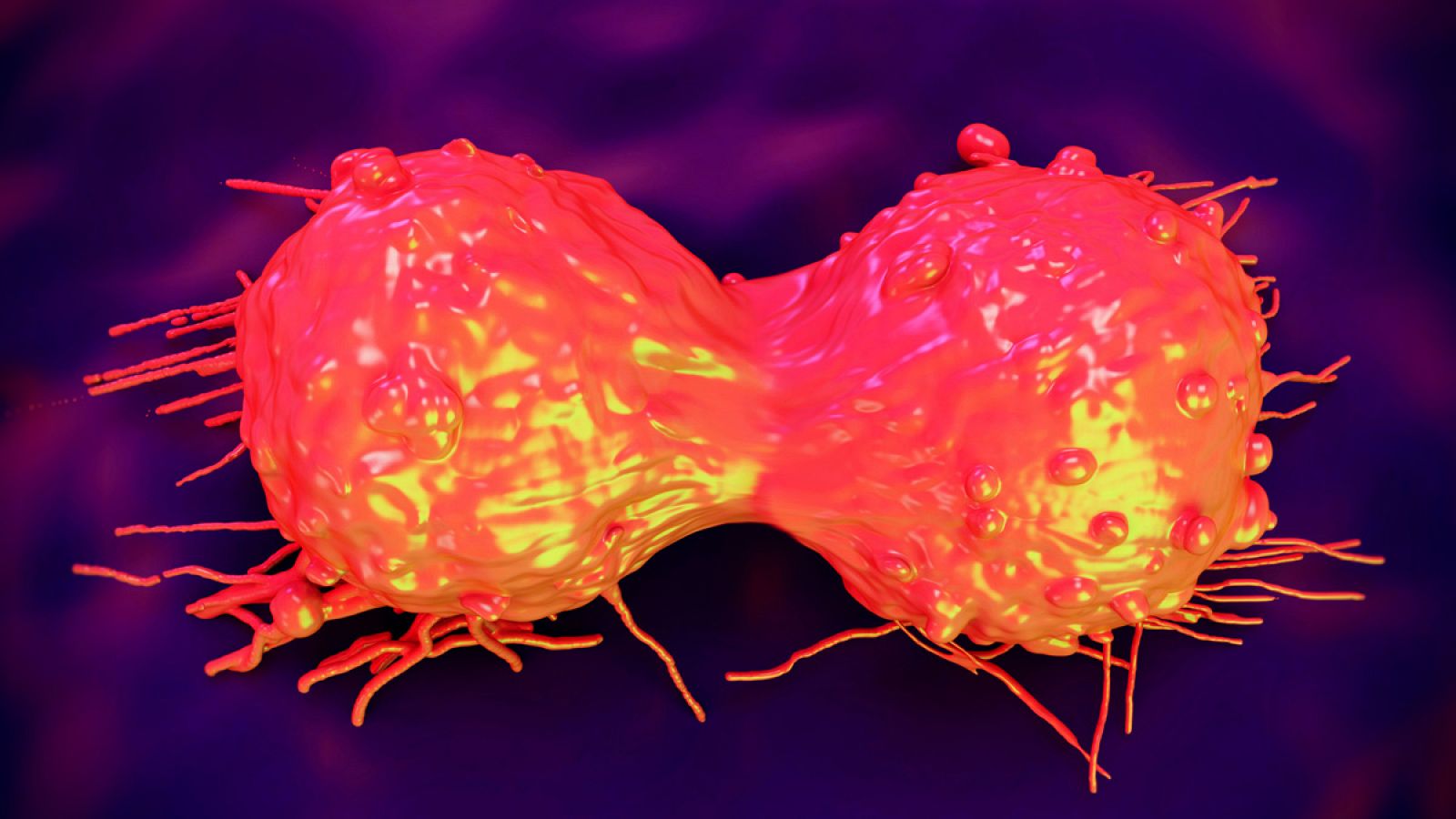 Representación de célula cancerígena en el cuello uterino.
