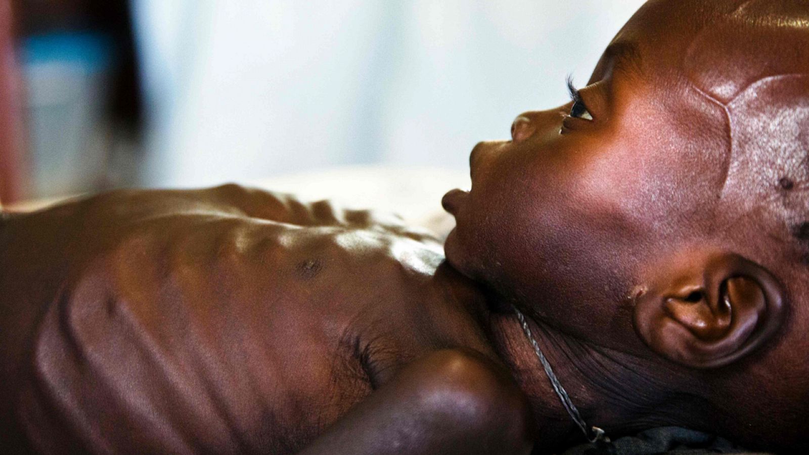 Agop Manut, niño sur sudanés de 11 meses, afectado de malnutrición, fotografiado en Awell, Sudán del Sur