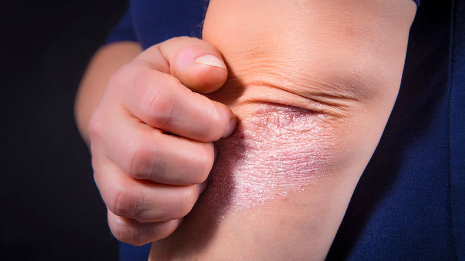 La psoriasis es una enfermedad autoinmune con efectos visibles en la piel.