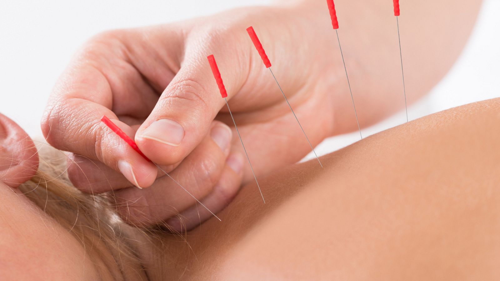 La acupuntura es una forma de medicina alternativa en la que se insertan agujas en el cuerpo.