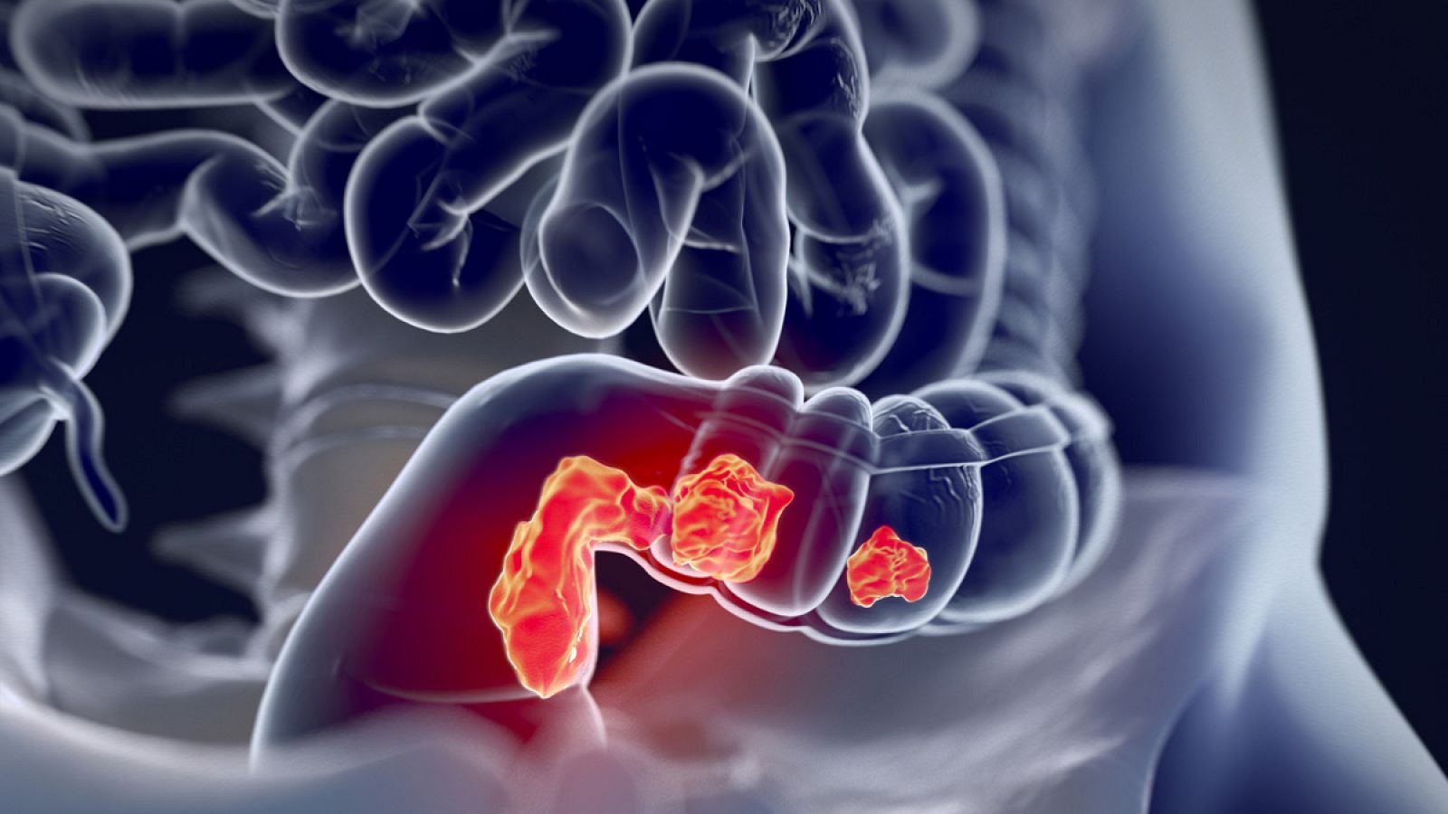 Una ilustración médica en 3D de un cáncer de colon