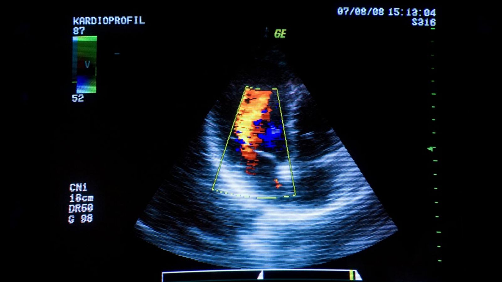 Imagen de archivo de una prueba cardiaca de diagnóstico.