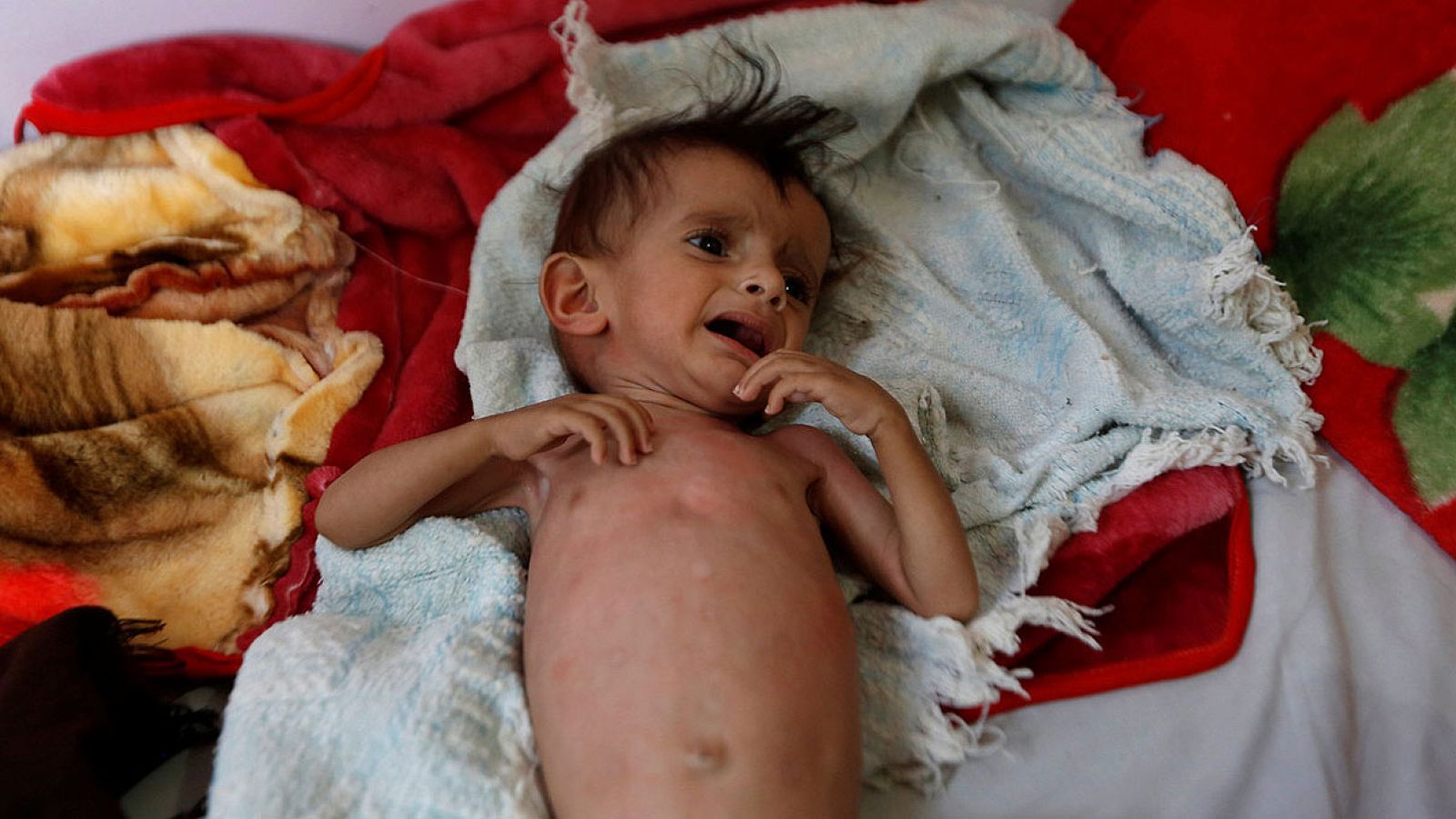 Un niño en un centro de tratamiento de la malnutrición en Saná, Yemen