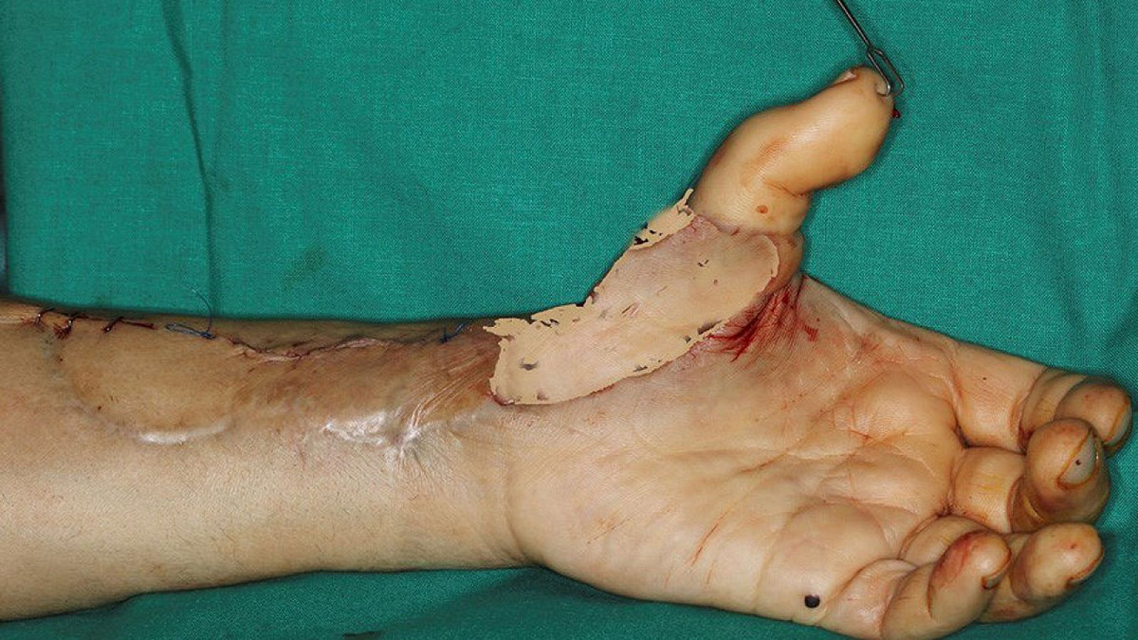 Un trasplante permite recuperar la funcionalidad en la mano con un dedo del pie
