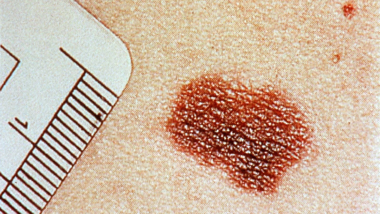 El melanoma, el carcinoma basocelular y el carcinoma epidermoide son los tres cánceres de piel más frecuentes.