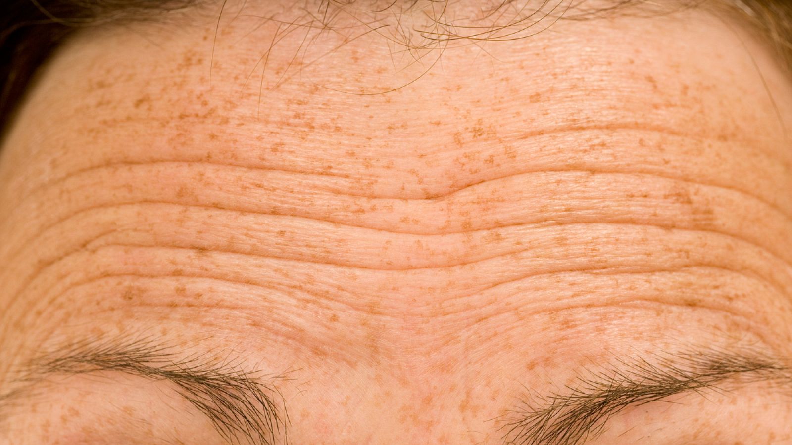Imagen de arrugas en al frente de una persona