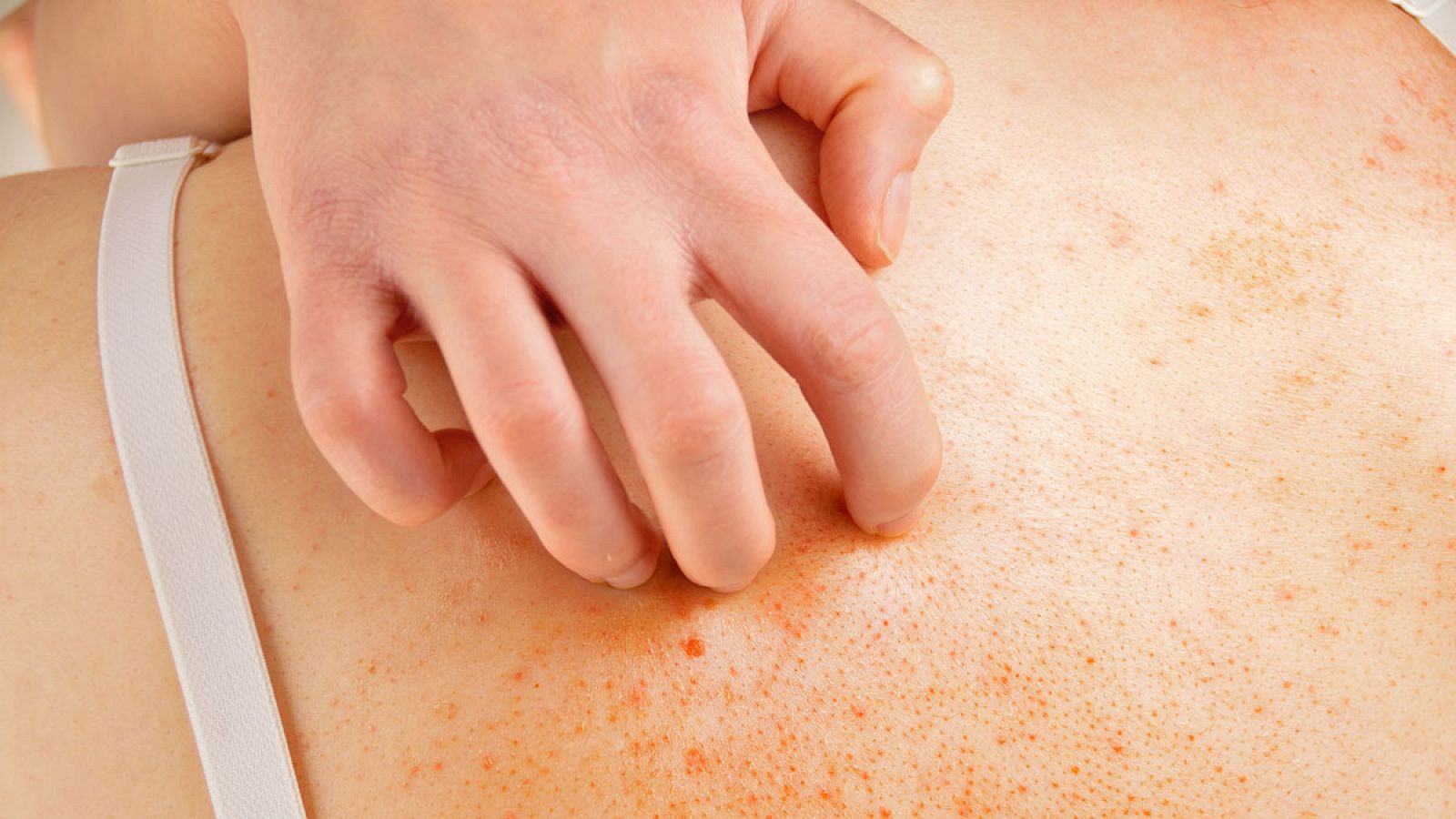 La forma severa de la dermatitis atópica supone uno de cada cinco casos.