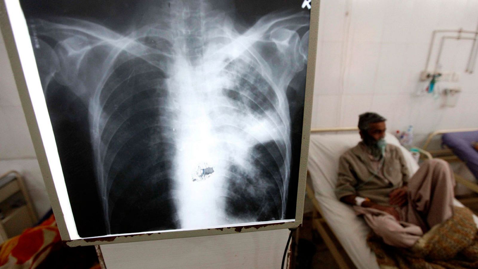 Un paciente enfermo de tuberculosis recibe tratamiento médico en un hospital de Peshawar, Pakistán.