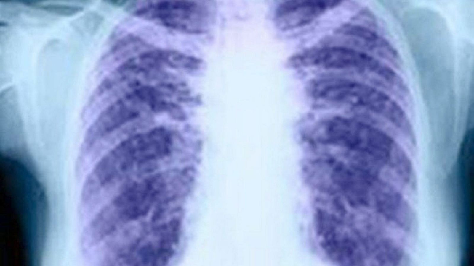 Una radiografía de unos pulmones.
