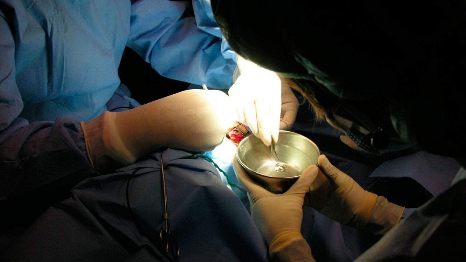 El Consorcio Internacional de Periodistas de Investigación denuncia 25.000 fallos en prótesis médicas en la última década