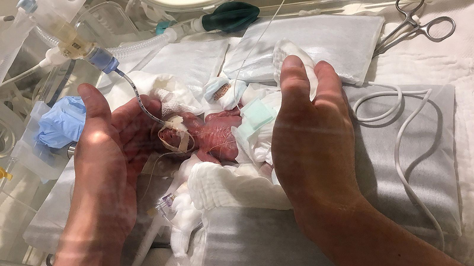 Bebé prematuro en Japón, nacido con 268 gramos, el más pequeño del mundo