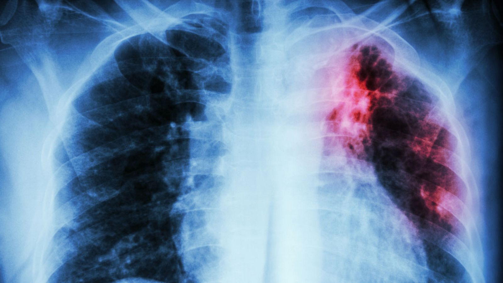Radiografía de un paciente afectado por tuberculosis.